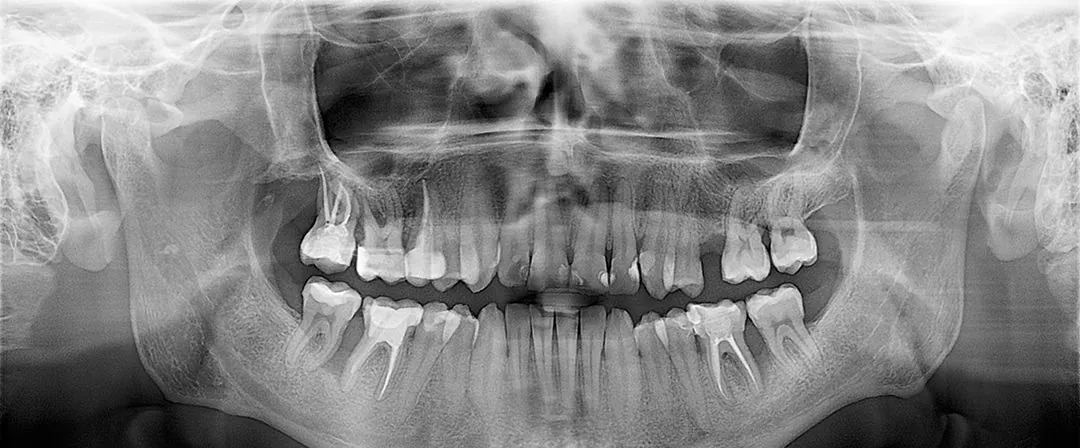 Panoramic X-ray showing all the upper and lower teeth, with the upper and lower jaw