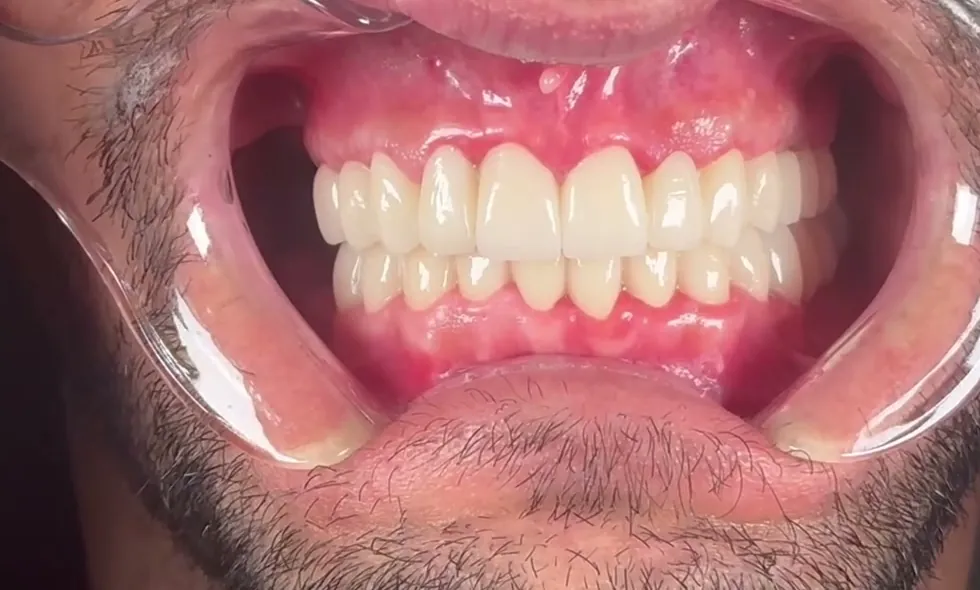 Upper and lower arches restored with fixed restorations on the patient's own teeth, at the end of treatment