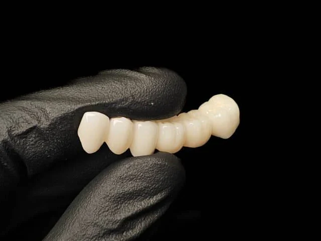 D'Original restoration seen from the front, with the zirconia crowns