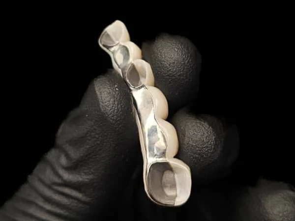 D'Original restoration seen from the back, with the titanium framework