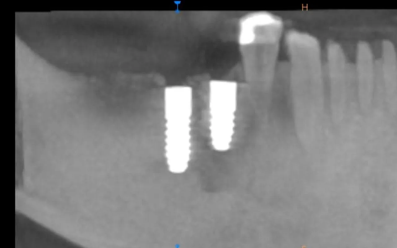 Tomografie cu două implanturi în osul arcadei de jos, lângă dinții naturali