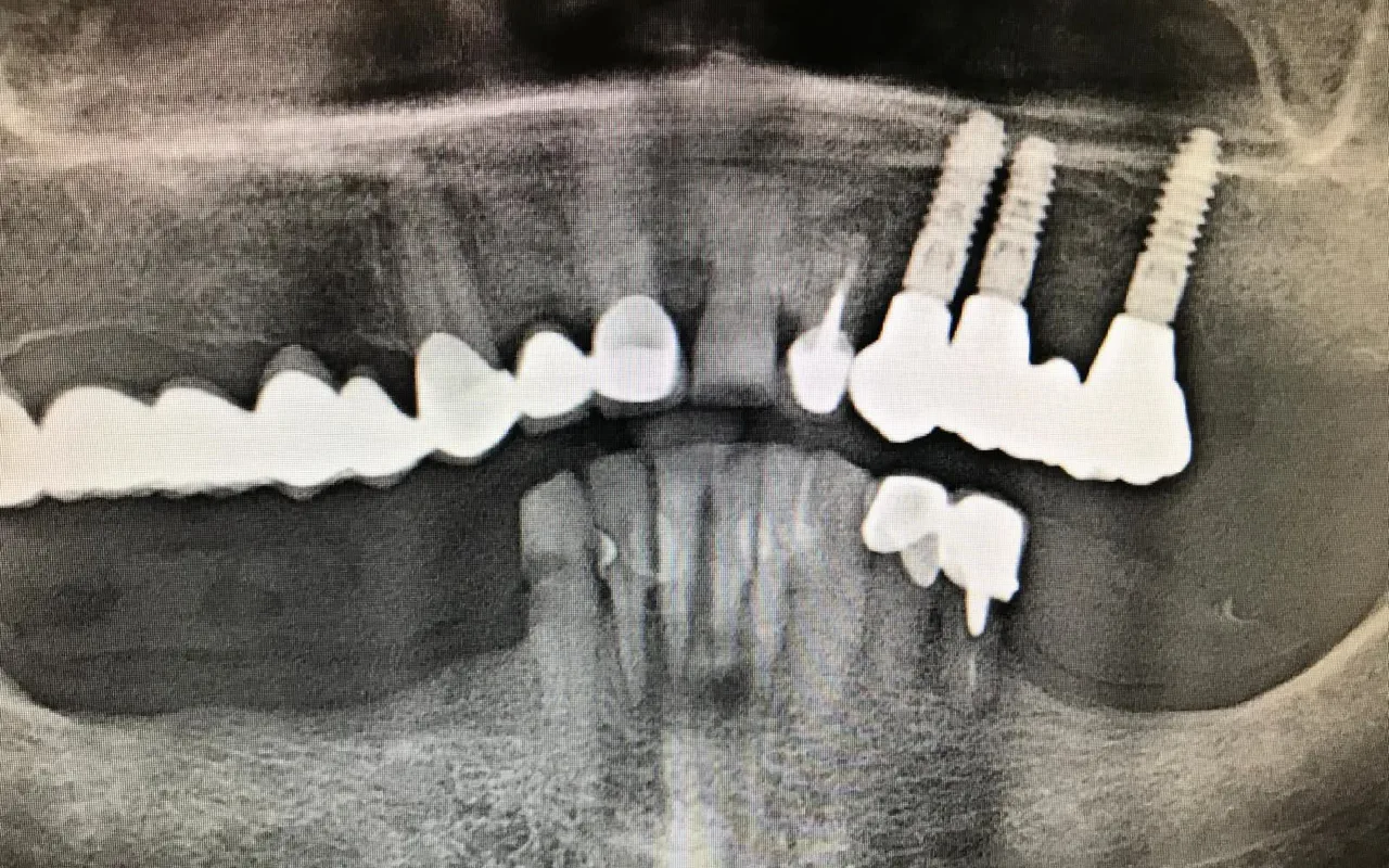 Radiografie panoramică cu trei implanturi și coroanele lor pe arcada de sus