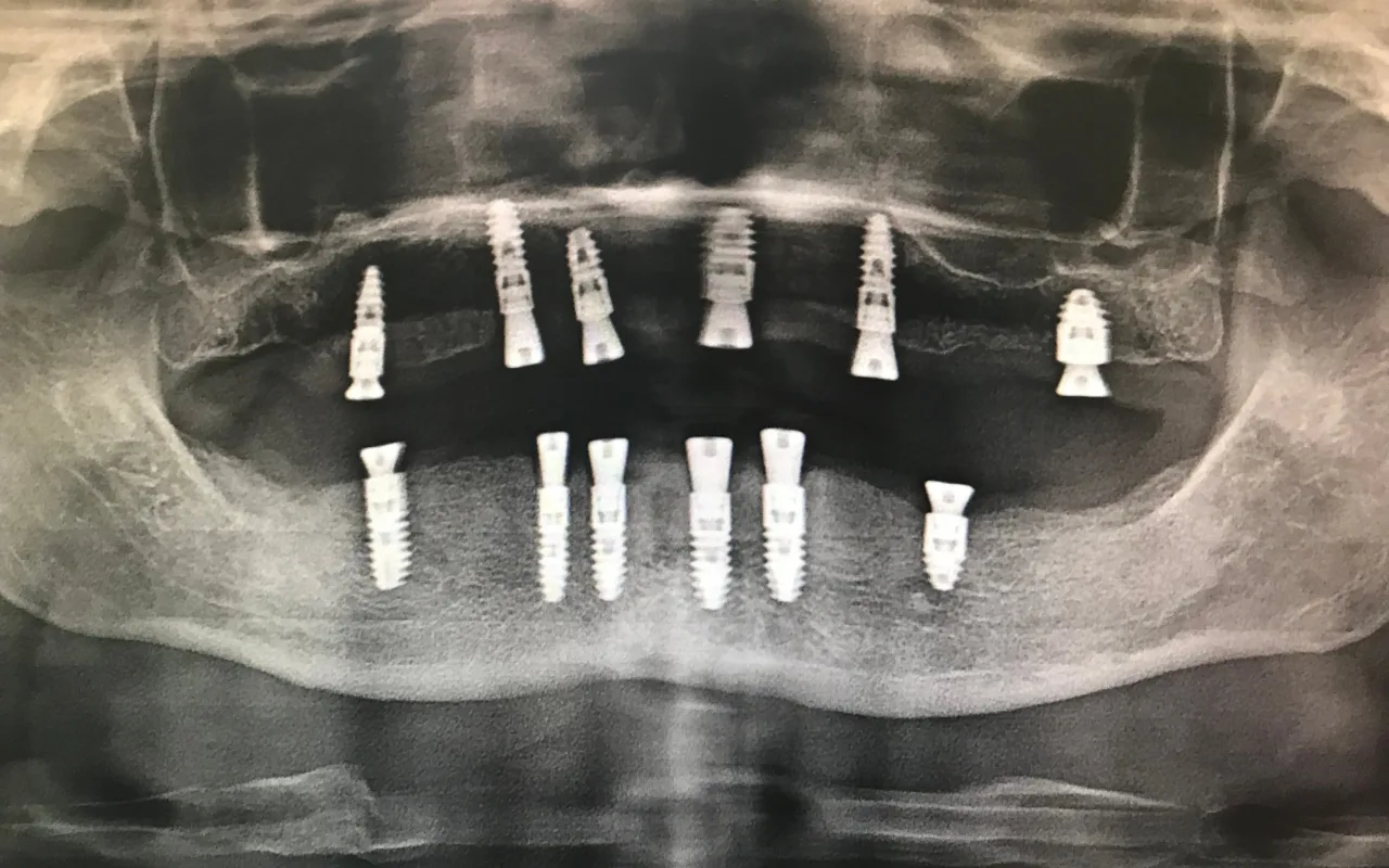 Radiografie panoramică cu implanturi pe arcada de sus și pe cea de jos