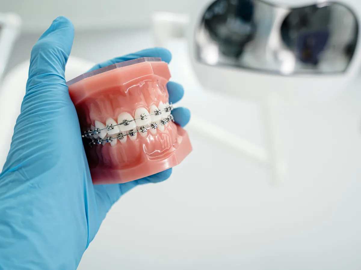 Model dentar cu aparat dentar fix, ținut într-o mână cu mănușă albastră