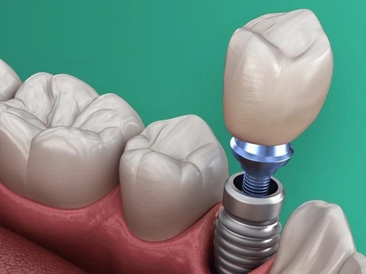 3D-printed surgical guides and dental models, for planning implants
